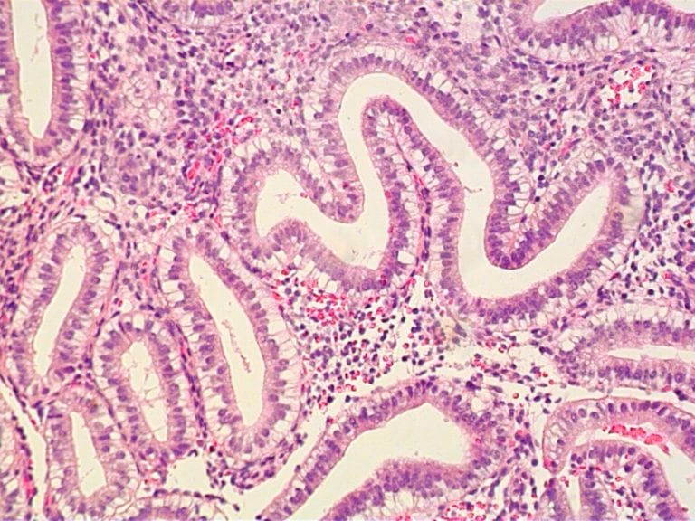 Endometrial Receptivity Analysis ACIMC Endometrial Receptivity Analysis ACIMC